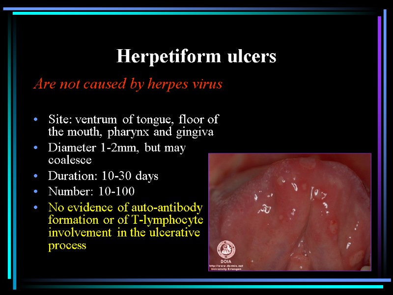 Herpetiform ulcers Are not caused by herpes virus  Site: ventrum of tongue, floor